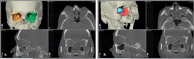 Navigational Transmaxillary Endoscopic Approach for Inferomedial Tumors